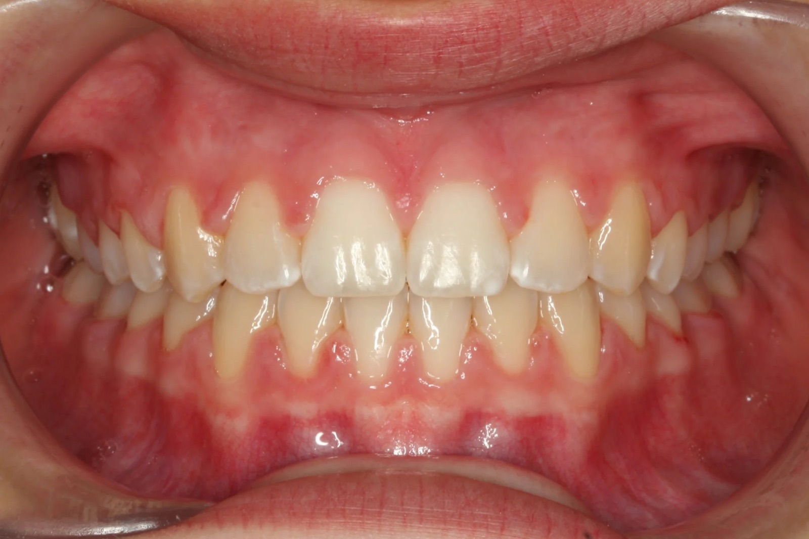 After treatment: front view of the teeth, case 1.