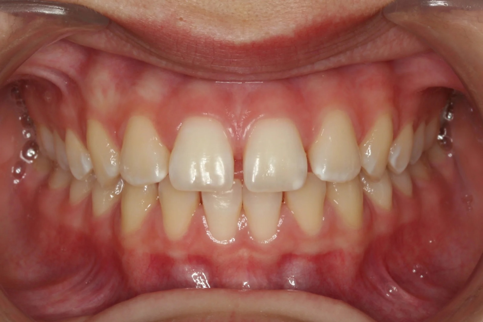 Before treatment: front view of the teeth, case 1.