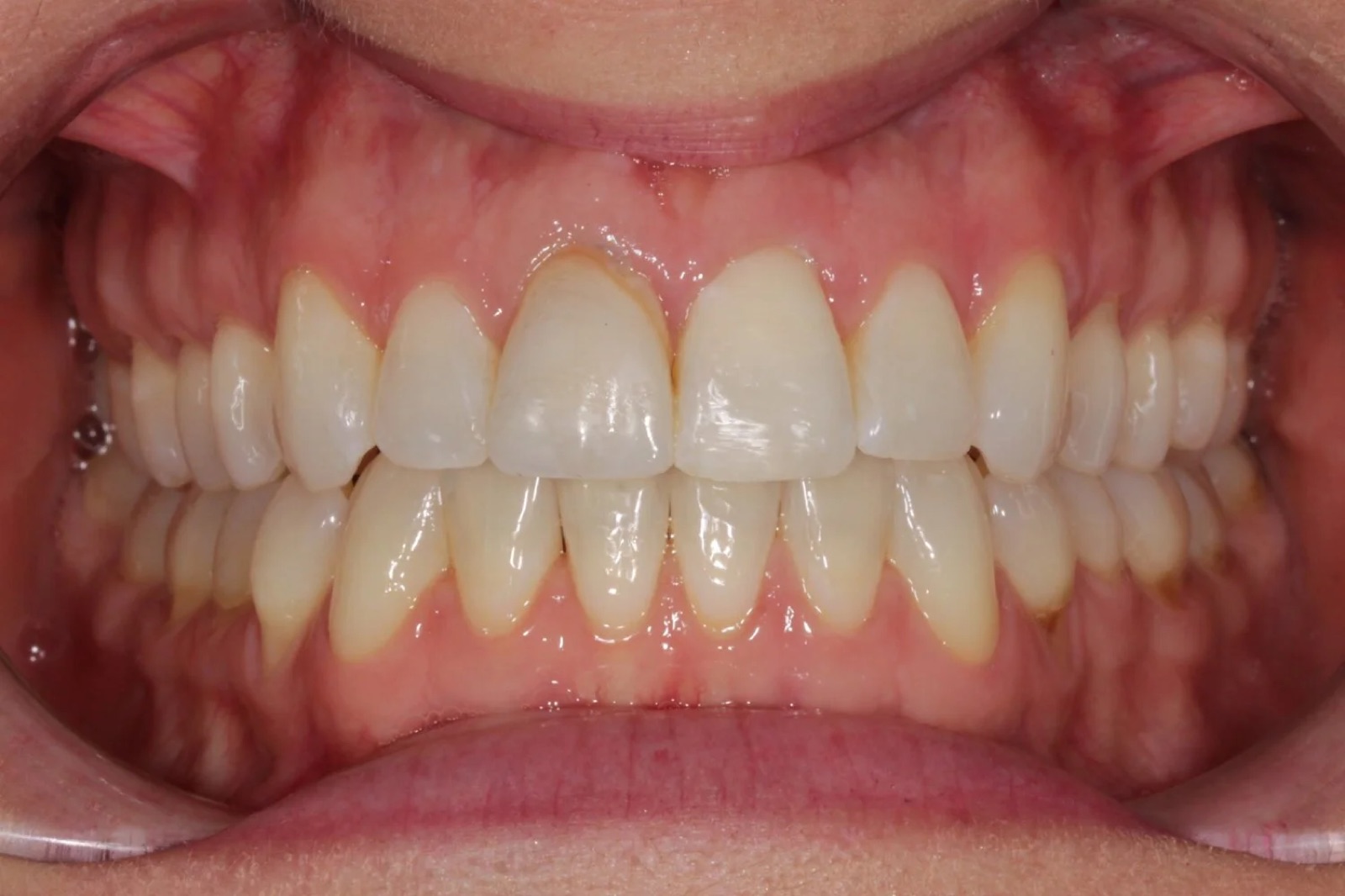 After treatment: front view of the teeth, case 2.