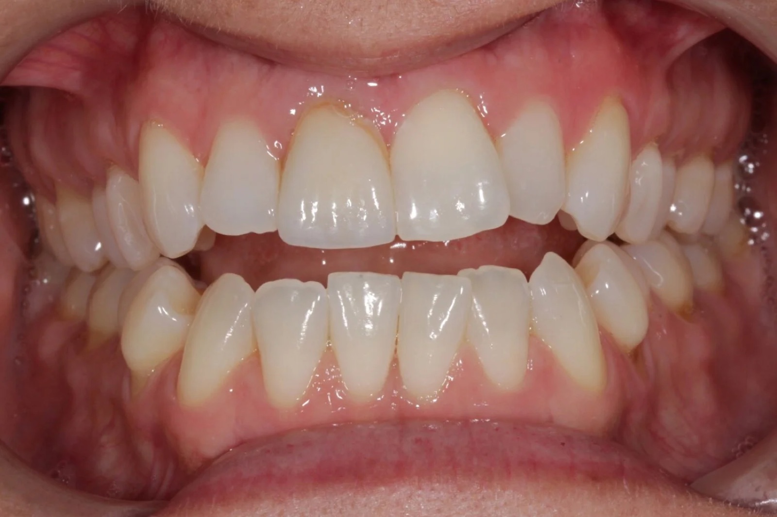 Before treatment: front view of the teeth, case 2.