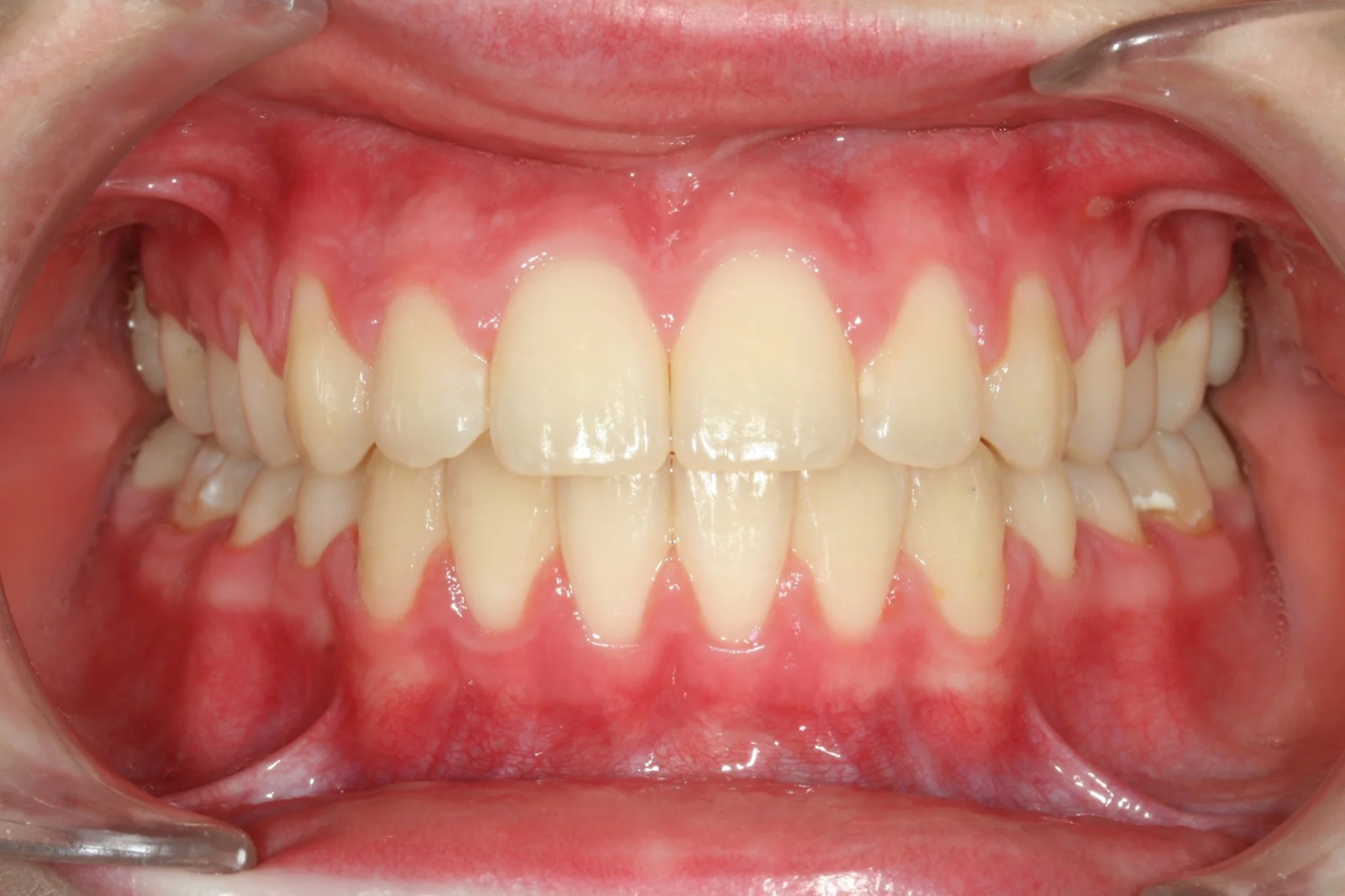 After treatment: front view of the teeth, case 3.