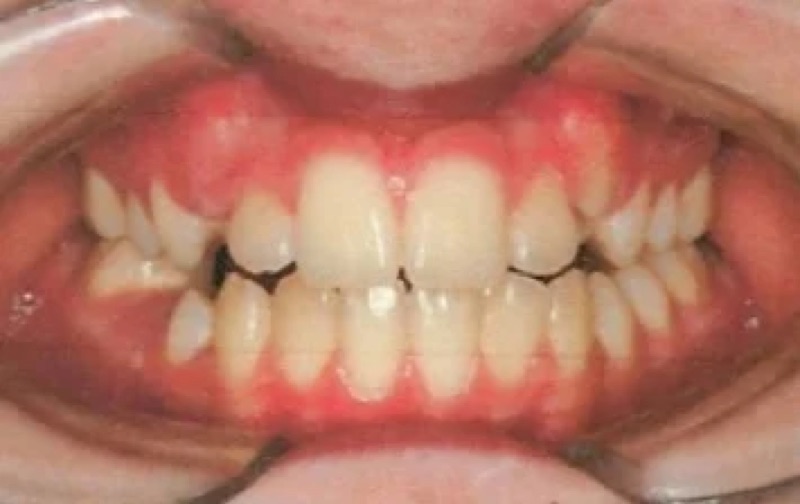 Before treatment: front view of the teeth, case 3.