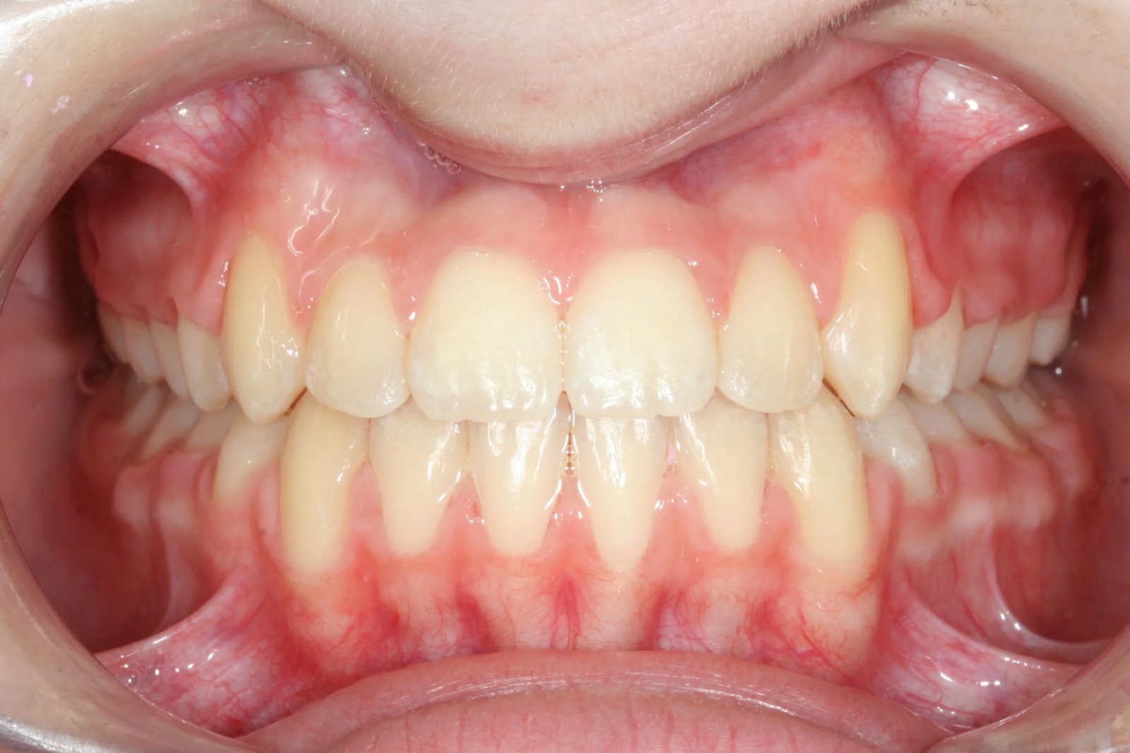 After treatment: front view of the teeth, case 4.