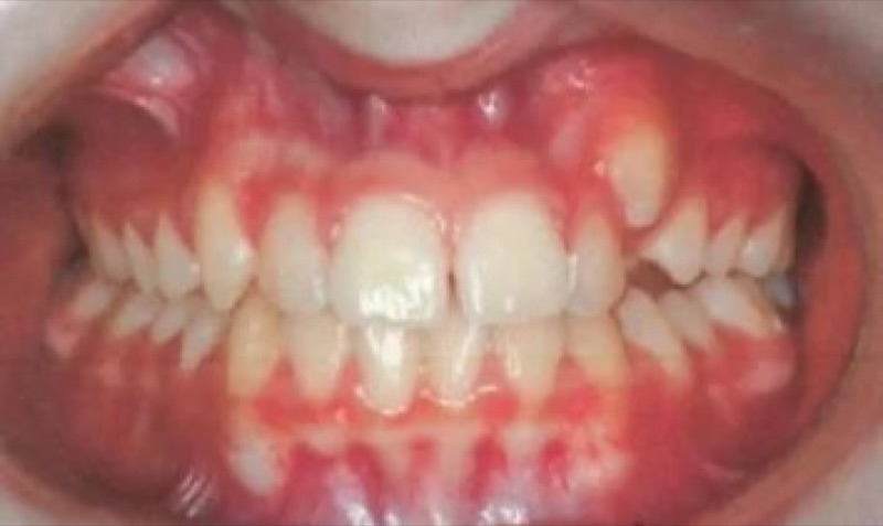 Before treatment: front view of the teeth, case 4.