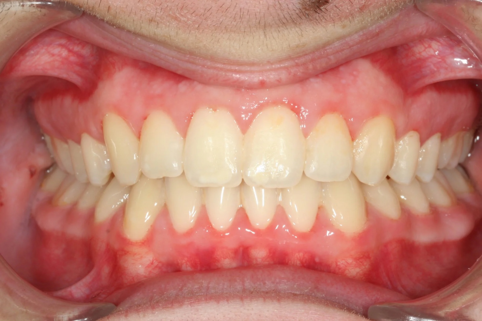 After treatment: front view of the teeth, case 5.