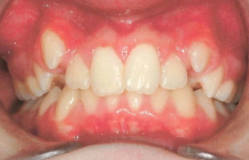 Before treatment: front view of the teeth, case 5.