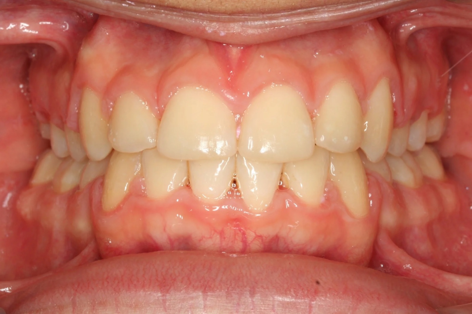 After treatment: front view of the teeth, case 6.