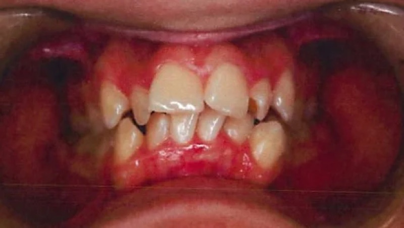 Before treatment: front view of the teeth, case 6.