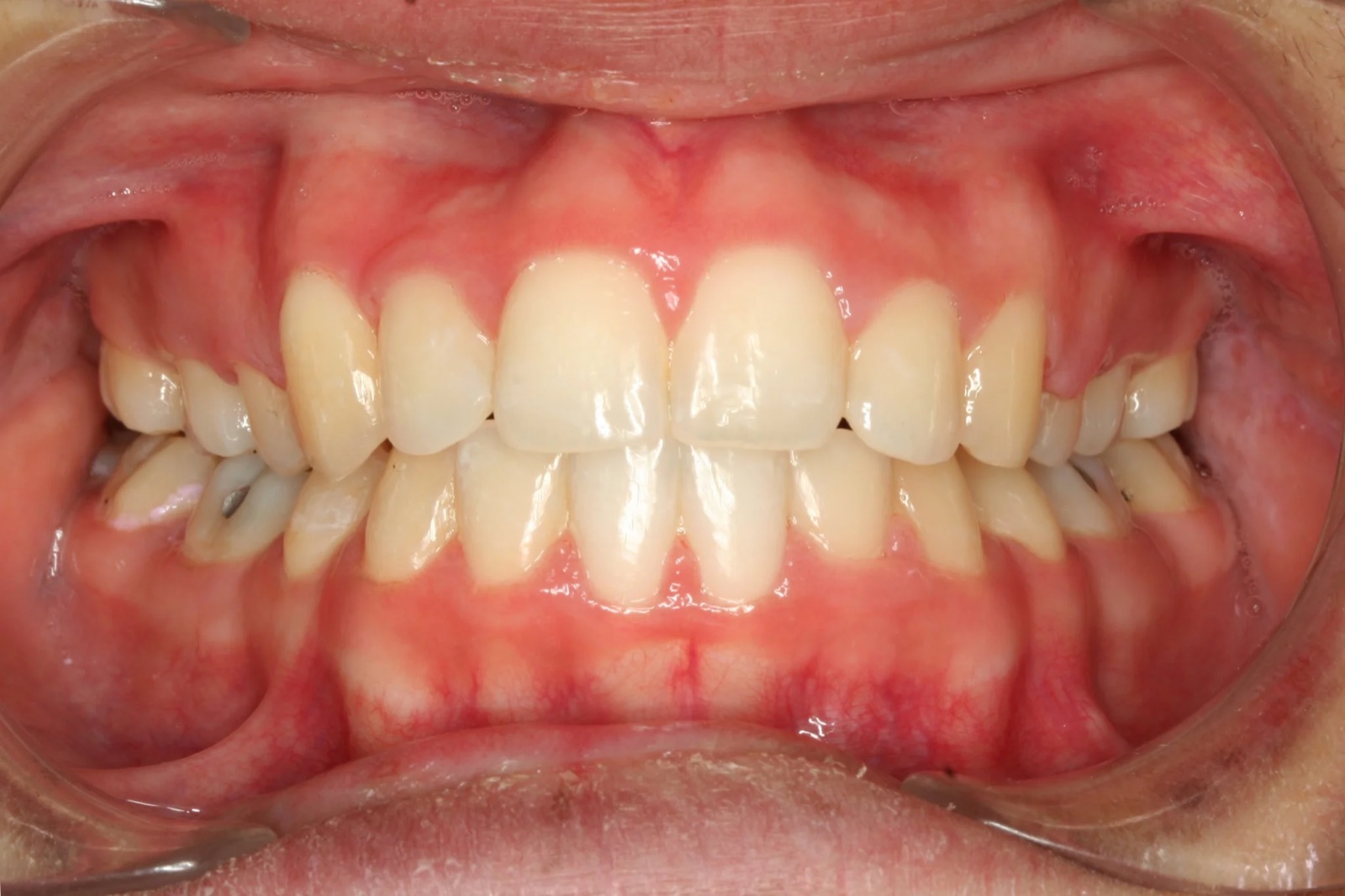 After treatment: front view of the teeth, case 7.