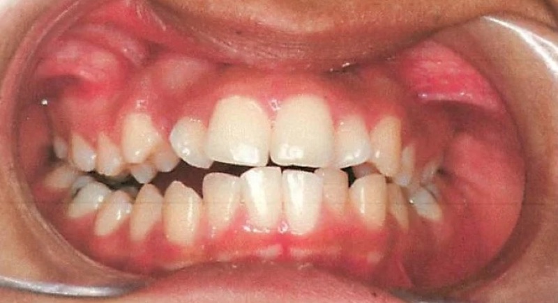 Before treatment: front view of the teeth, case 7.