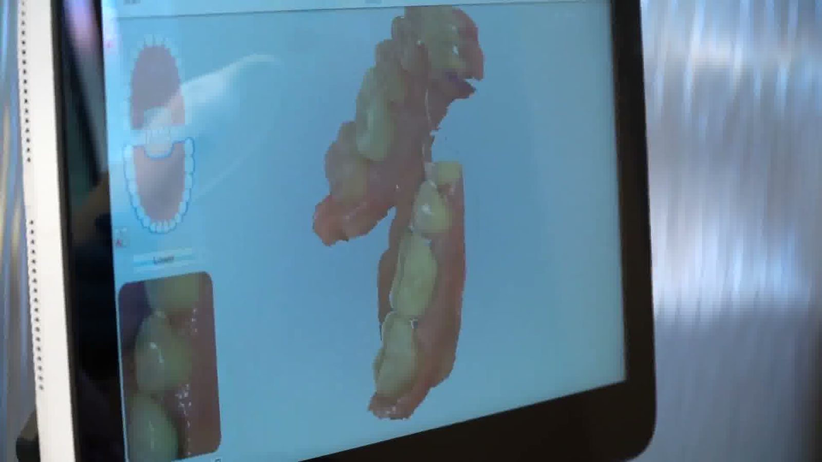 A digital scan of the teeth on the scanner screen.